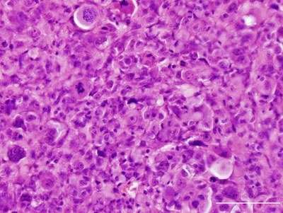 研究人员阐明突变在胶质母细胞瘤中的作用