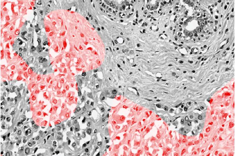 Scientists develop new way to identify telltale markers for breast cancer tumors