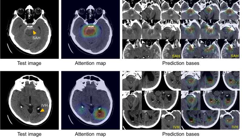Artificial intelligence system learns to diagnose, classify intracranial hemorrhage