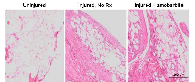 Acute treatment suppresses posttraumatic arthritis in ankle injury