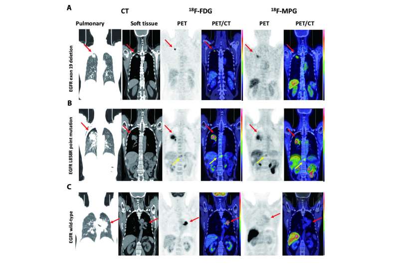 Imaging agent helps predict success of lung cancer therapy