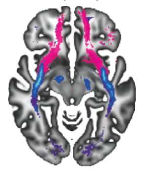Pathways in the young brain are associated with susceptibility for mental disorders