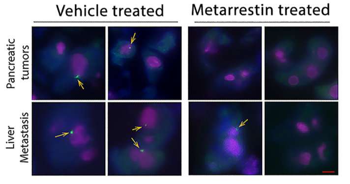 Scientists develop potential new approach to stop cancer metastasis