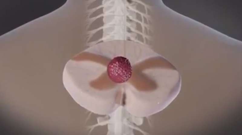 Magnetic nanoparticles deliver chemotherapy to difficult-to-reach spinal tumors