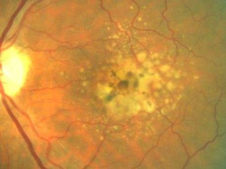 Better assessments for early age-related macular degeneration
