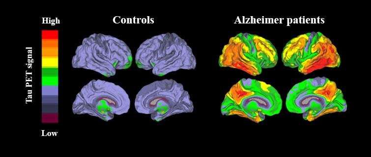 New method enables accurate diagnosis of Alzheimer's disease