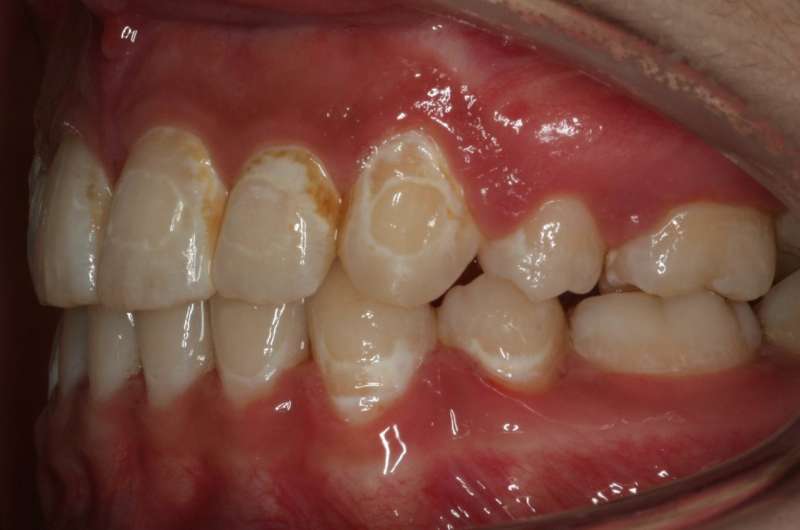 New dental adhesive prevents tooth decay around orthodontic brackets