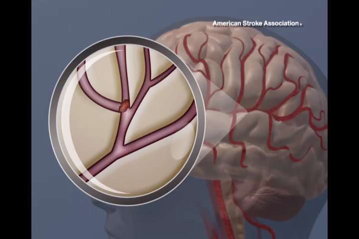 Experimental vaccine may reduce post-stroke blood clot risk