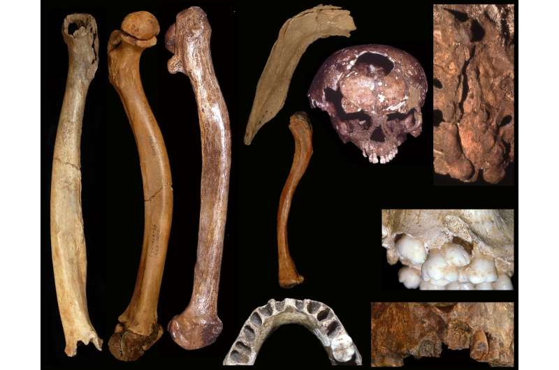 **Anthropologist finds high number of developmental anomalies in Pleistocene people