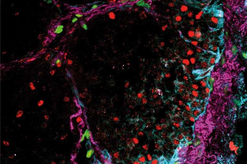The “wrong” connective tissue cells signal worse prognosis for breast cancer patients