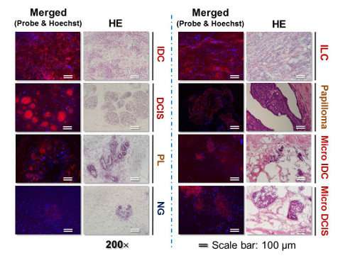 Scientists develop system to rapidly and accurately detect tumor margins during breast cancer surgery