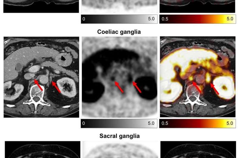 Researchers identify pitfall in popular prostate cancer PET imaging method