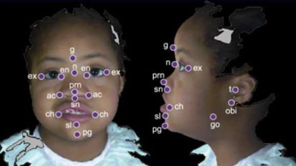 Researchers using 3D facial scans to aid diagnosis of children with rare genetic syndrome