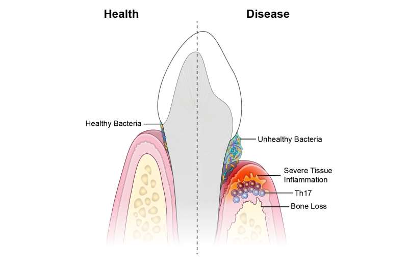 Researchers identify immune culprits linked to inflammation and bone loss in gum disease