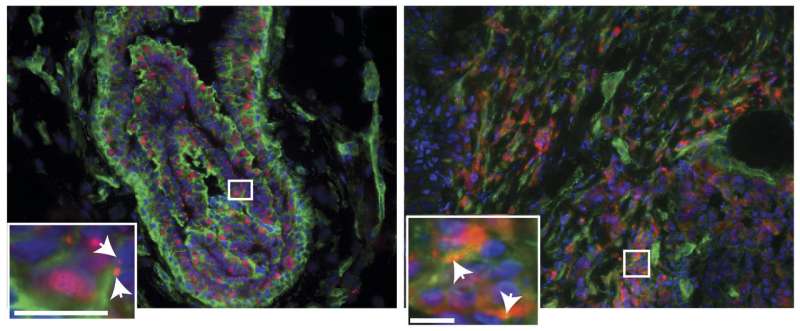 Breast cancer growth signals are enhanced by a protein outside cells