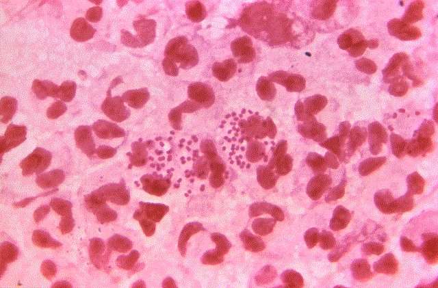When it comes to gonorrhea, gender matters