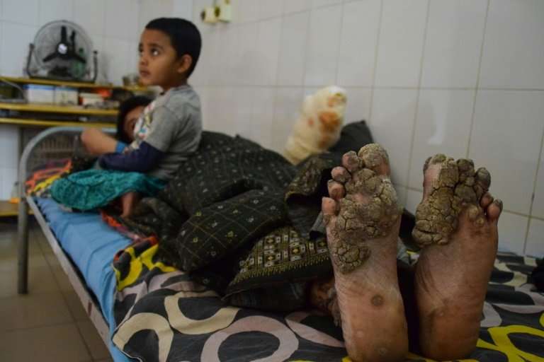 Abul Bajandar suffers from epidermodysplasia verruciformis, an extremely rare genetic condition known as &quot;tree-man disease&