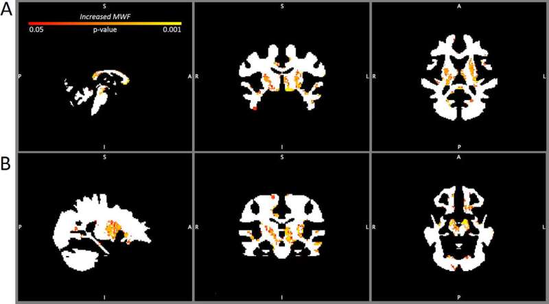 Acute and chronic changes in myelin following mild traumatic brain injury