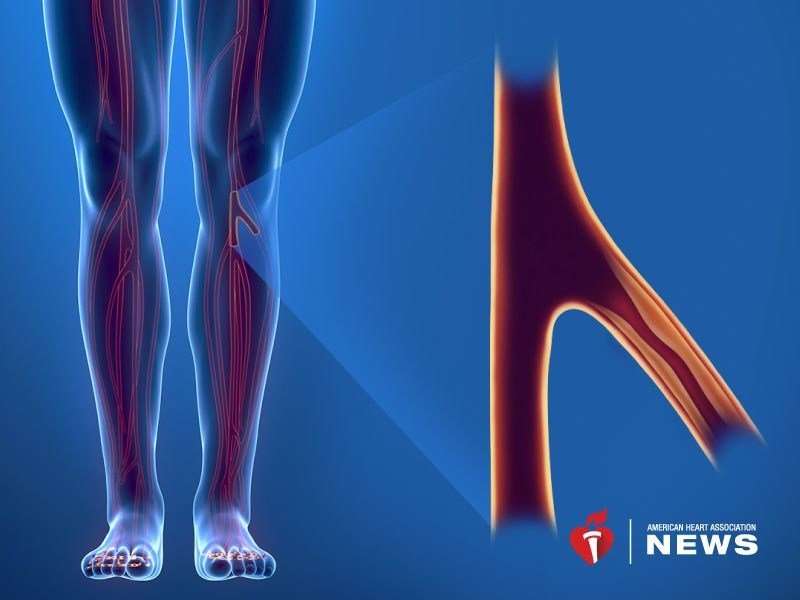 AHA: obesity may increase risk for peripheral artery disease