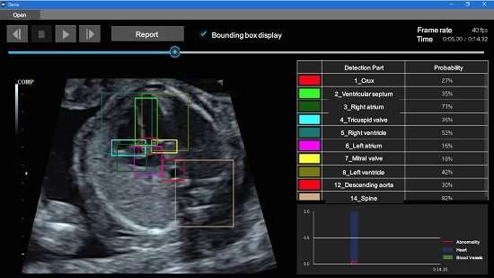 AI used to detect fetal heart problems