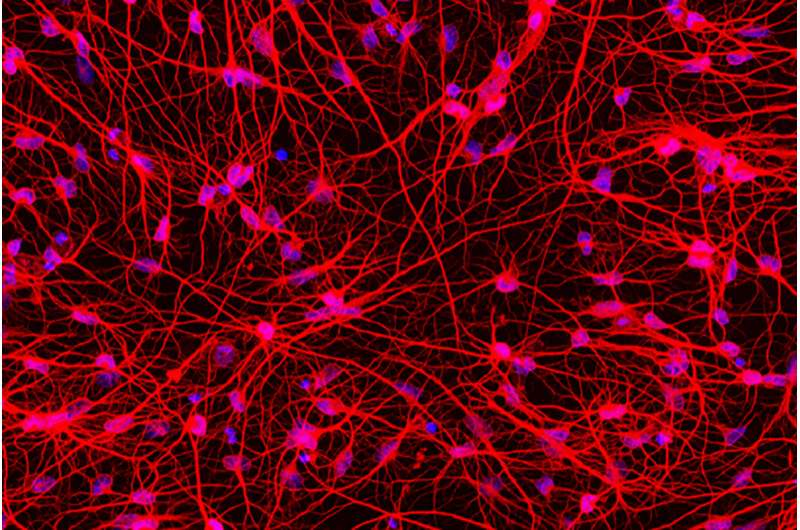 Altering Huntington's patients' skin cells into brain cells sheds light on disease
