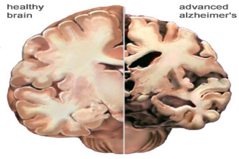 Alzheimer's vs normal brain
