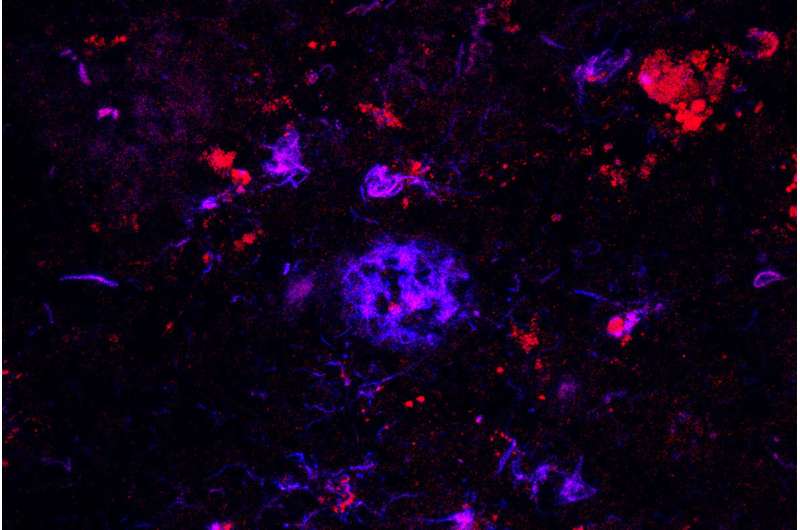 Antibody removes Alzheimer's plaques, in mice