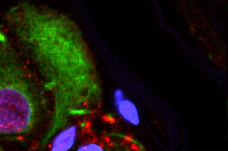 Appendix identified as a potential starting point for Parkinson's disease