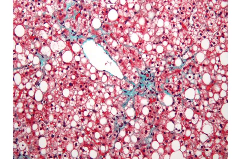 Big data studies scrutinize links between fatty liver disease and how cells make energy