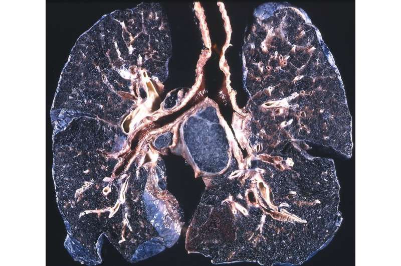 Black lung disease on the rise