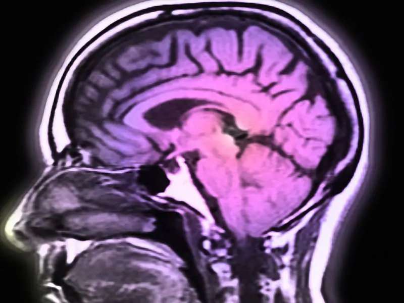 Brain iron on MRI linked to disability in multiple sclerosis