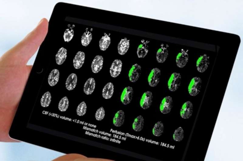 Brain-scan guided emergency stroke treatment can save more lives