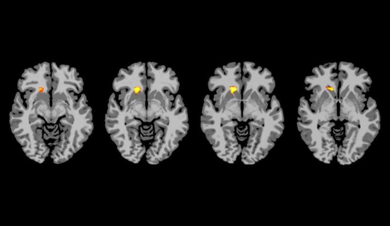 Brain scans show why some type 1 diabetics miss low blood sugar cues