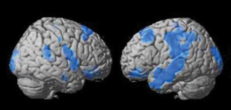 脑SPECT成像可预测抑郁症患者的预后