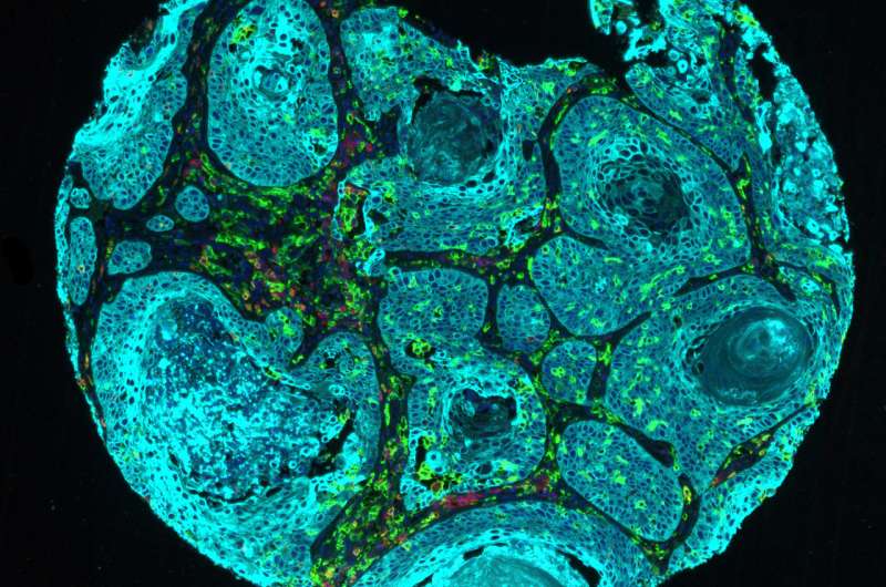 By forming clots in tumors, immune cell aids lung cancer's spread