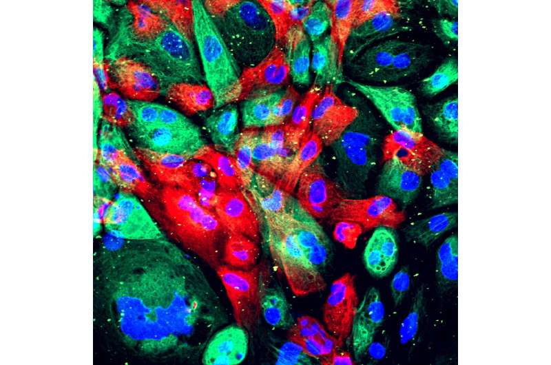 Cancer's gene-determined 'immune landscape' dictates progression of prostate tumors