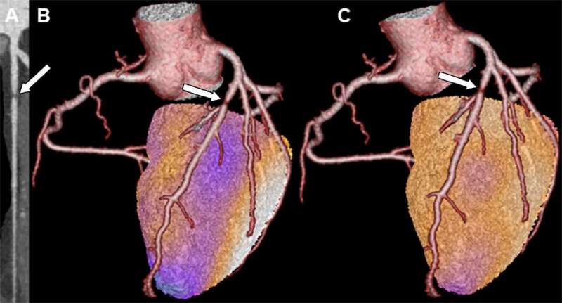 Cardiac hybrid imaging an effective tool for predicting heart attacks