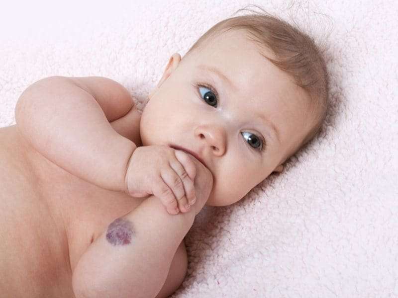 Certain birthmarks warrant quick treatment, pediatricians say
