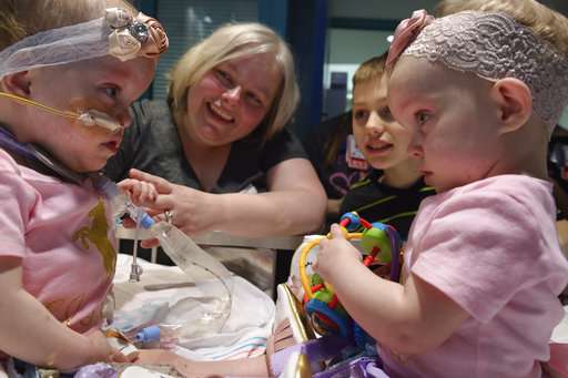 Conjoined twins separated at Houston hospital discharged
