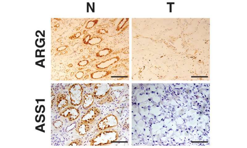 Depleted metabolic enzymes promote tumor growth in kidney cancer