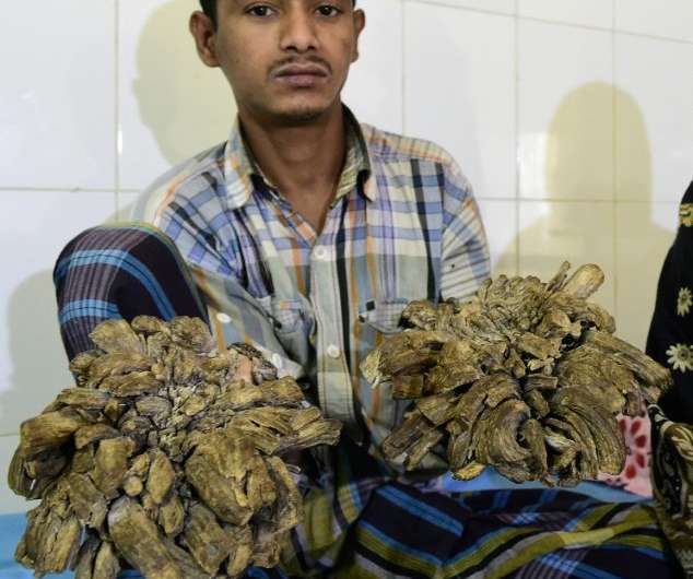 Dhaka doctors had surgically removed more than five kilos (11 pounds) of growths from Bajandar's hands and feet