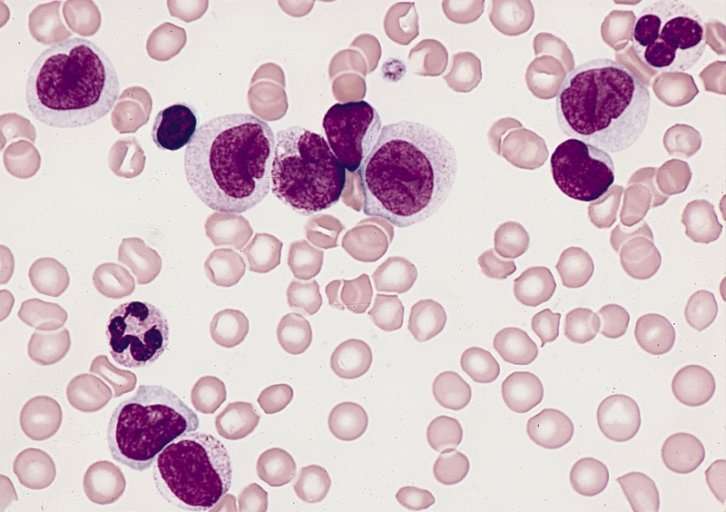 DNA test for predicing risk of leukemia relapse