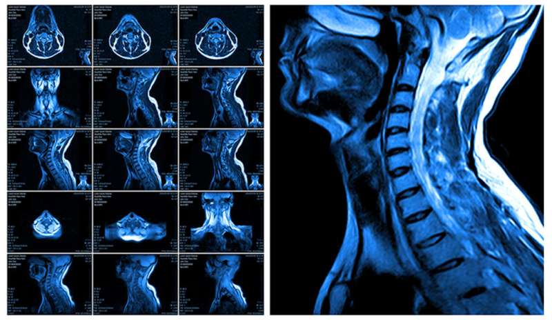 Do patients with neck injuries really need that MRI after a normal CT?