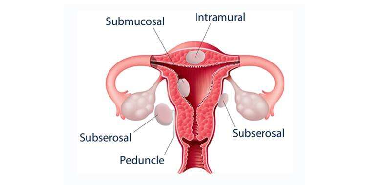 Elagolix reduces menstrual bleeding from most common uterine tumors
