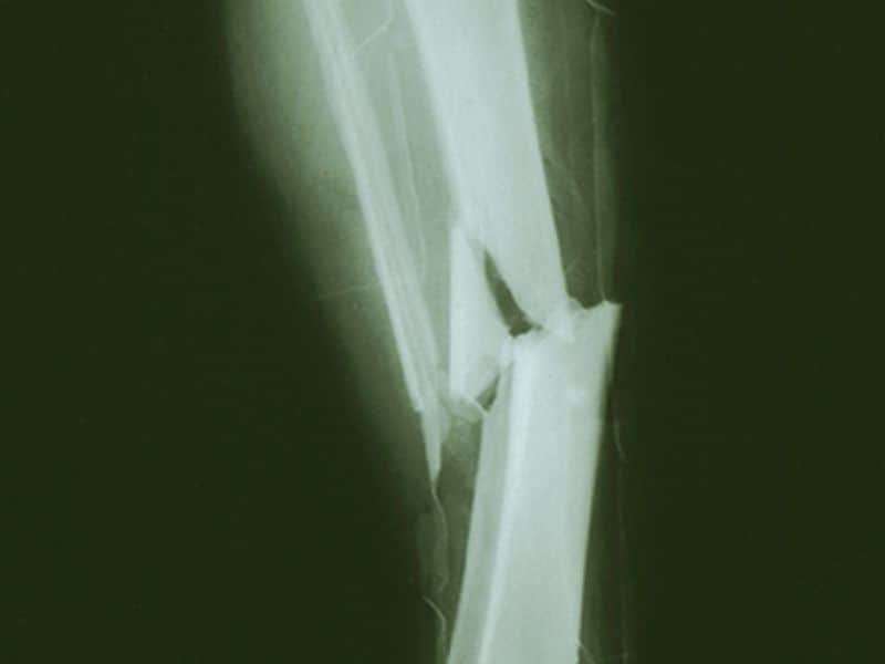 Empagliflozin doesn't up risk of bone fractures