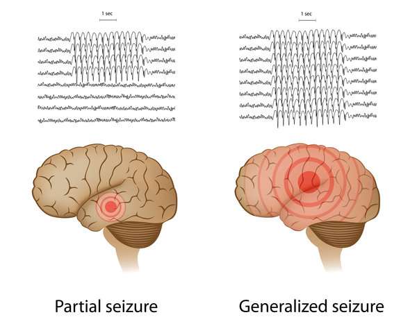 Epileptic seizures and depression may share a common genetic cause, study suggests