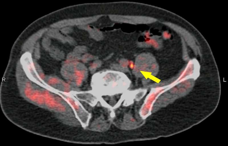 Fluciclovine PET/CT locates recurrent prostate cancer and advises management