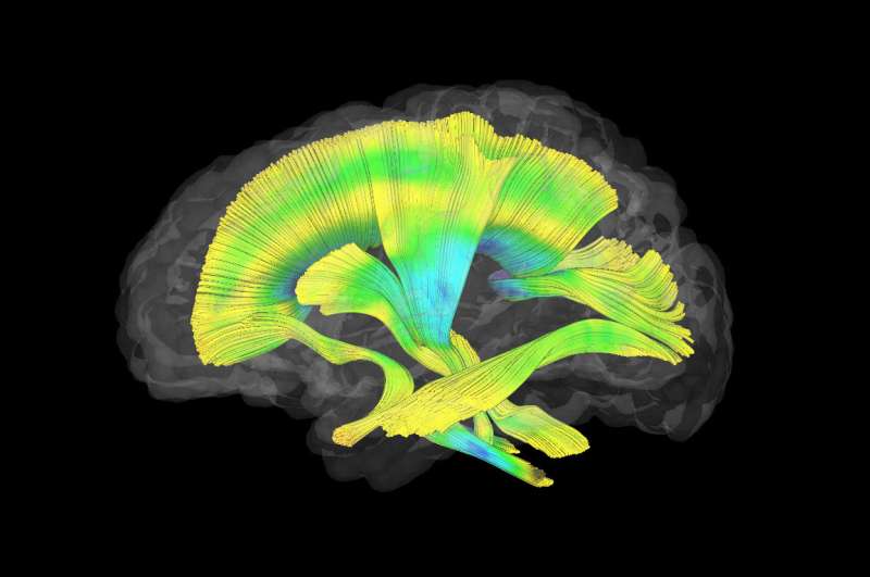 Fragile X imaging study reveals differences in infant brains