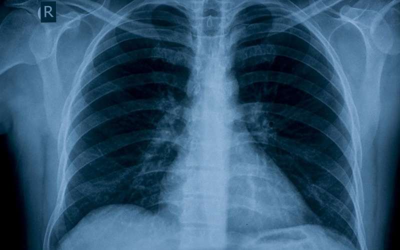 Genetic study could lead to new treatments for sufferers of pulmonary arterial hypertension
