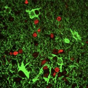Gene variant found in brain complicit in MS onset